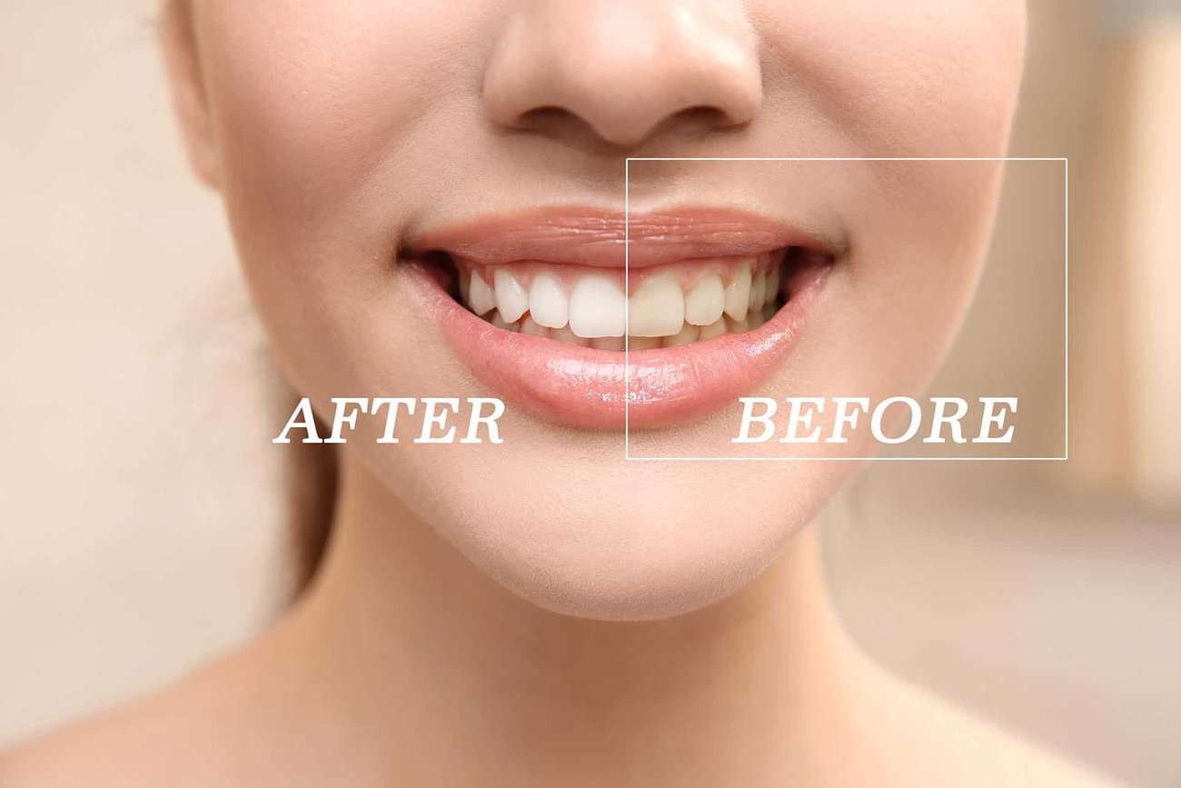 What Are the Most Effective Natural Teeth Whitening Methods You Can Try Kingswood?