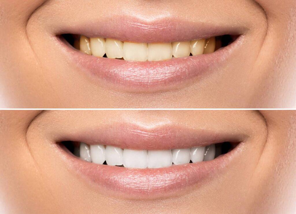 How Can You Protect Your White Smile as a Coffee Lover Kingswood?