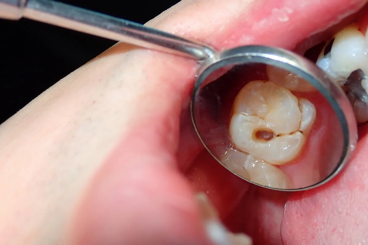 Why Do Teeth Crack? Common Causes to Know Kingswood