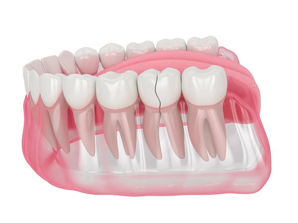 How Can You Manage Pain and Discomfort After a Root Canal Kingswood?