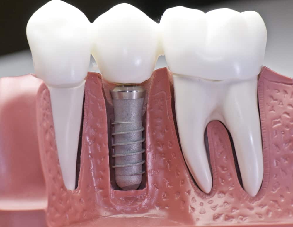 Common Misconceptions About Modern Dental Treatments Kingswood