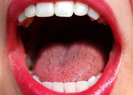 Common Causes of Dry Mouth (Xerostomia) Kingswood