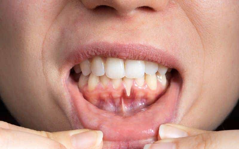 How Can Gum Disease Be Prevented Kingswood?