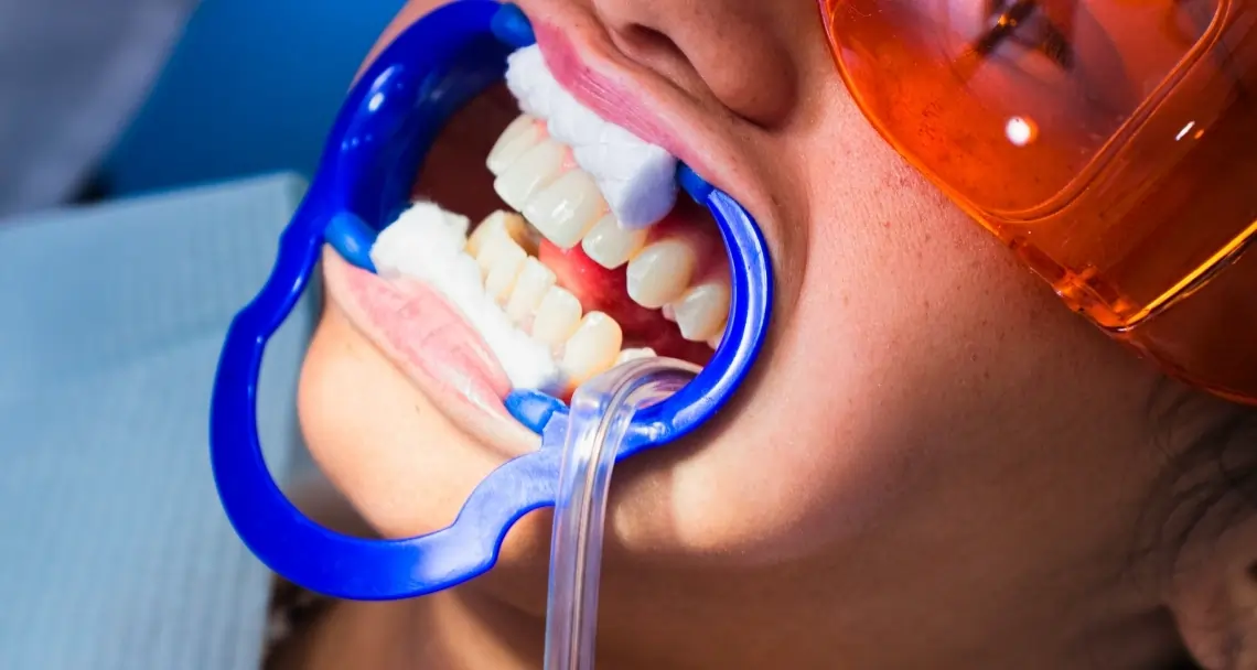 How Teeth Whitening Treatments Actually Work on Your Enamel Kingswood