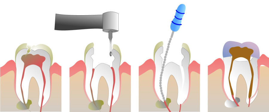How Do You Properly Care for Your Teeth After a Root Canal Kingswood