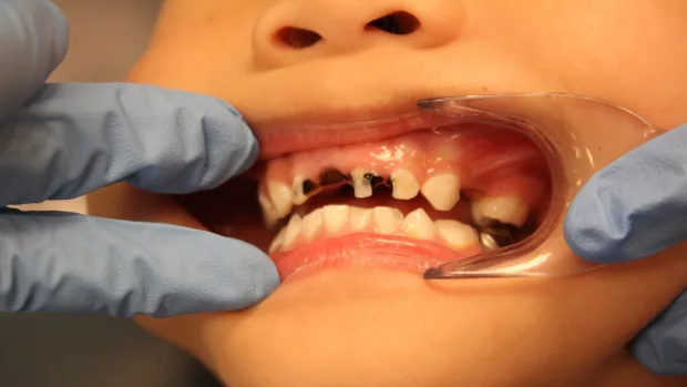 Which Foods and Drinks Cause the Most Damage to Young Smiles Kingswood?