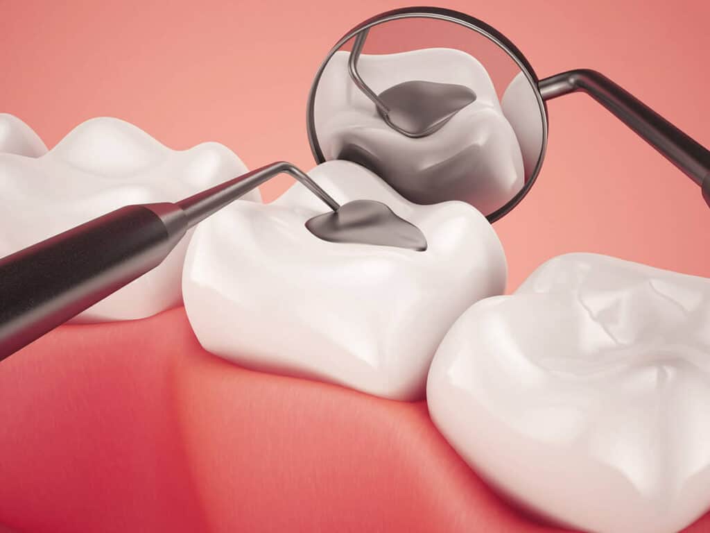 How Can You Prevent Tooth Decay Effectively Kingswood