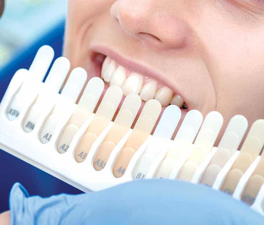 Professional vs At-Home Whitening: What You Need to Know Kingswood