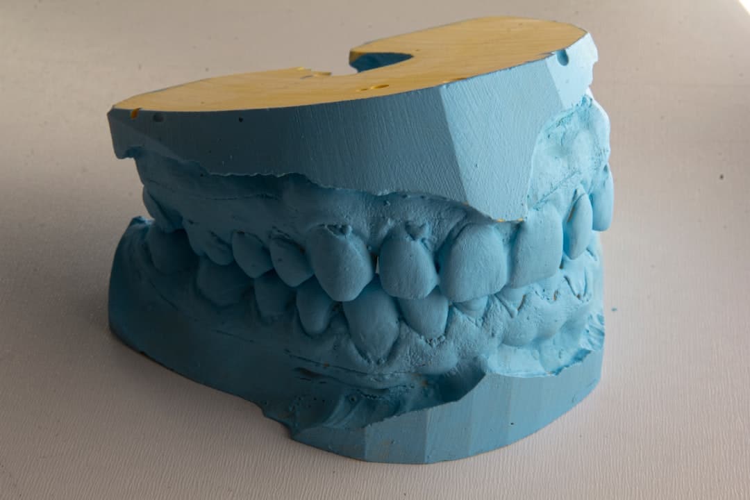 How Do Dental Implants Improve Jawbone Health and Oral Function Kingswood?
