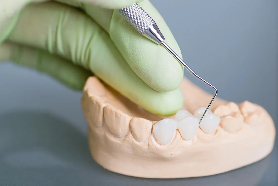 What Are the Different Types of Dental Crowns Available Kingswood?