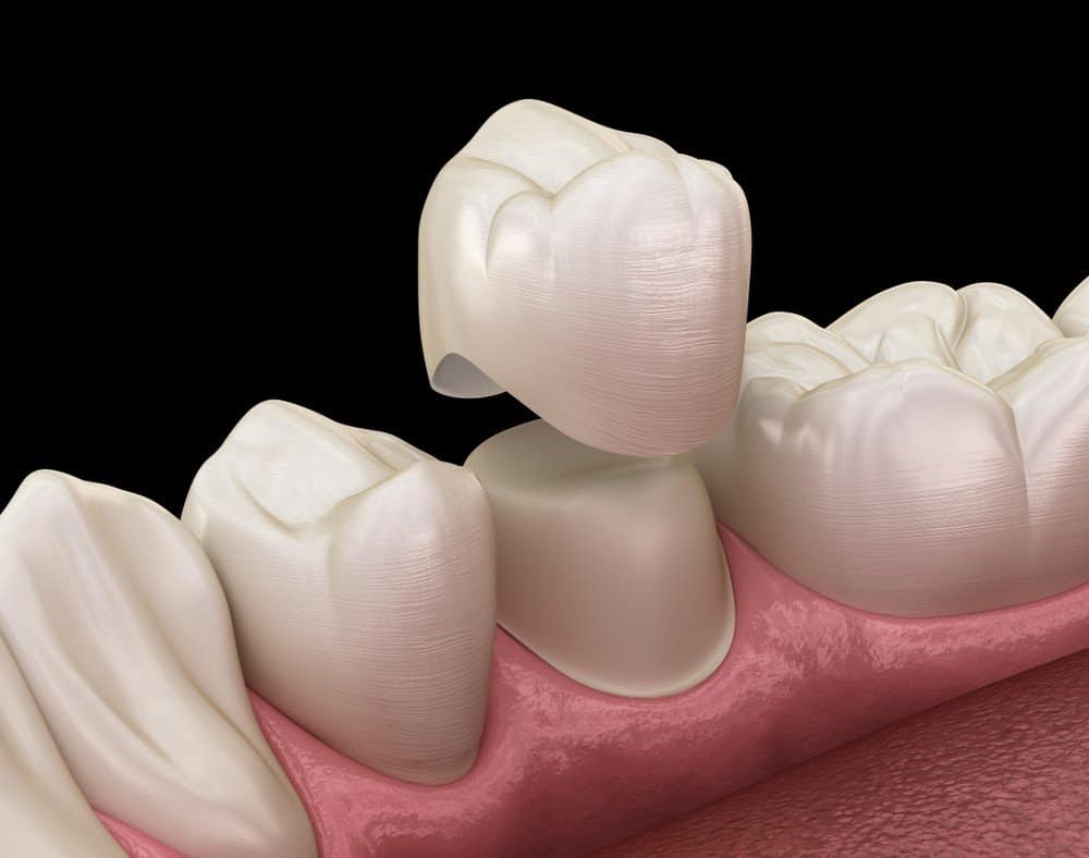 Teeth Whitening: Separating Facts from Fiction Kingswood