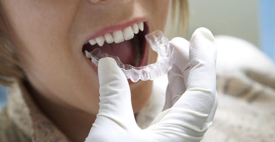 Can Bruxism Affect Your Sleep Quality Kingswood