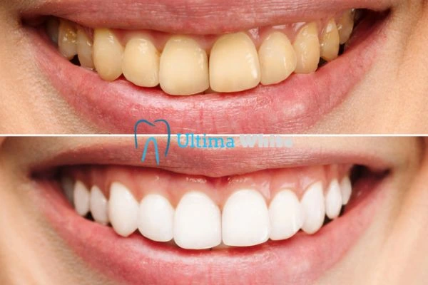 Oral Care Tips for Current and Former Smokers Kingswood