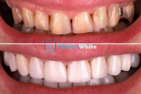 What Makes Instant Teeth Whitening Treatments So Popular Kingswood?