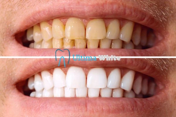 Stained Teeth and Persistent Bad Breath Kingswood